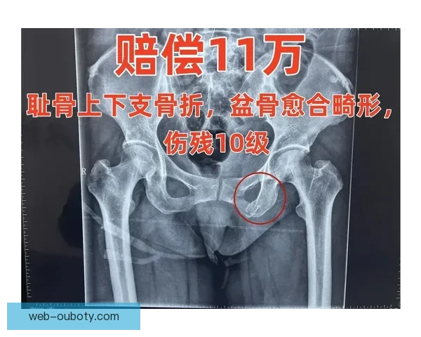 伊尼亚基透露尼科伤情耻骨伤势反复 伊尼亚基透露尼科伤情耻骨伤势反复